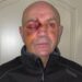Truck driver may still lose sight in one eye after wheelie bin attack